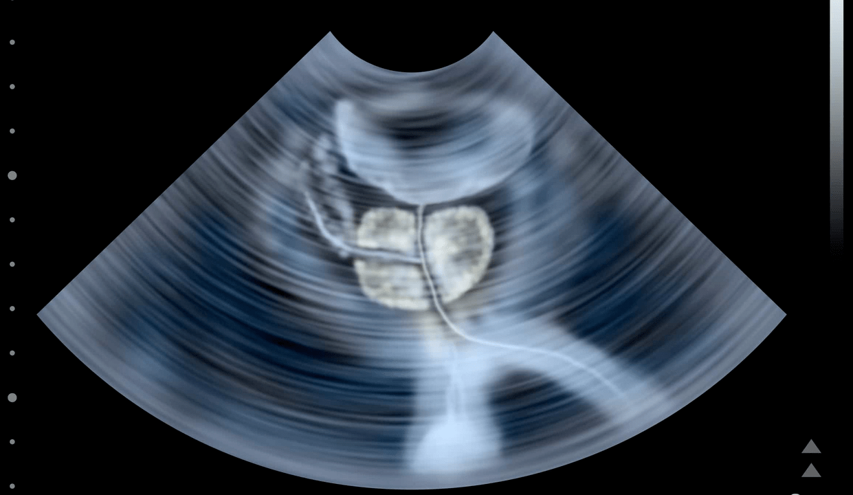 Ultrasound examination of calculous prostatitis